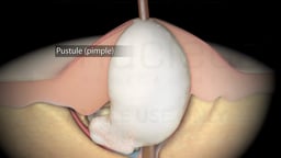 Types of Acne: Pustule (Pimple)