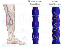 Venous Insufficiency
