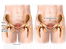 Normal Pelvis vs Pelvis with TOT Bladder Control System