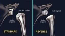 Comparison of Standard and Reverse Shoulder Replacements