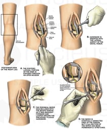 Surgical Repair of the Knee with Peroneal Nerve Damage