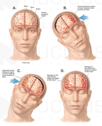 Whiplash - Side to Side Closed Head Injury