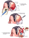 Brain Surgery - Craniotomy with Evacuation of Hematoma
