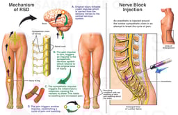 Traumatic Leg Injury with Resulting Reflex Sympathetic Dystrophy (RSD)