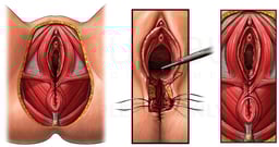 Fourth Degree Episiotomy with Recto-vaginal Fistula