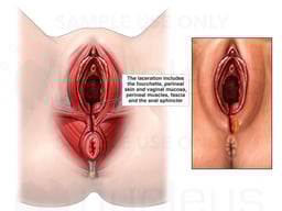 Third Degree Perineal Laceration