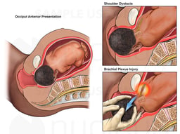 Birth Injury - Shoulder Dystocia