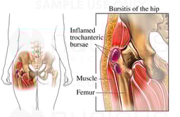 Bursitis of the Hip