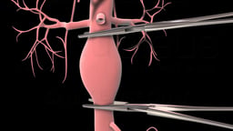 Open Abdominal Aortic Aneurysm Repair: Vascular Clamping