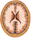 Brain with Lateral Ventricles, Cut-away View