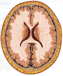 Brain with Lateral Ventricles, Cut-away View
