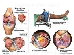 Right Knee Injuries with Arthroscopic Repairs