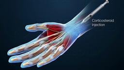 Corticosteroid Injection for Carpal Tunnel Syndrome in Hand Anatomy