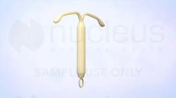 What is an IUD?