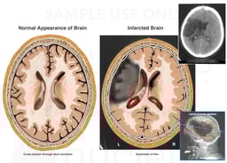 Large Area of Cerebral Infarction