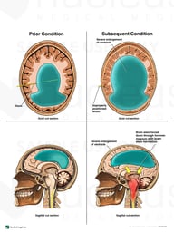 Improperly Positioned Shunt with Brain Stem Herniation