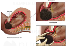 Shoulder Dystocia with Brachial Plexus Injury