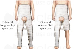 Hip Spica Casts