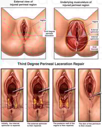 Correct Layered Repair of Third Degree Perineal Laceration