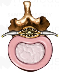 Lumbar Vertebra with Intervertebral Disc and Nerves