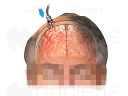 Insertion of Intracranial Pressure Monitor (ICP) Bolt