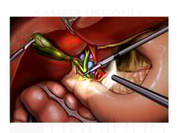 Common Bile Duct Injury During Cholecystectomy Procedure