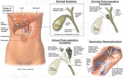 Cholecystectomy with Bile Leak and Surgical Reconstruction