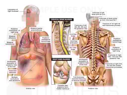 Front and Back Female Torso Figures with Injuries to the Cervical Spine and Knee