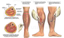 Compartment Syndrome of Left Leg with Surgical Fasciotomies