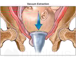 Attempts at Delivery with Prolapse of the Umbilical Cord