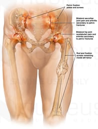 Future Medical Conditions of the Pelvis