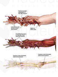 Traumatic Amputation of Right Arm