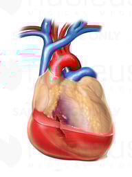 Right Ventricle with Associated Pericardial Hemorrhage