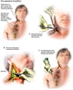 Debridement of Right Neck with Drainage of Neck Abscess
