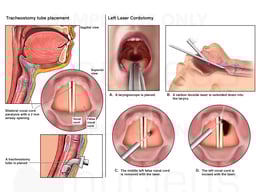 Tracheostomy and Left Laser Cordotomy