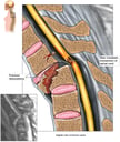 Post-accident Fracture Dislocation of the Thoracic Spine with Transection of Spinal Cord