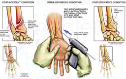 Post-accident Wrist Fractures with Surgical K-Wire Fixation