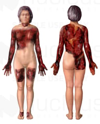 Burn Injuries to tbe Head, Upper Extremities, Chest Back and Thighs