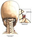 Skeletal Head and Neck with Right C7 Transverse Process Fracture