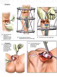 Surgical Procedures