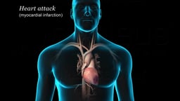 Myocardial Infarction (Heart Attack) in Left Ventricle