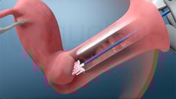 What Happens During a Pap Test?