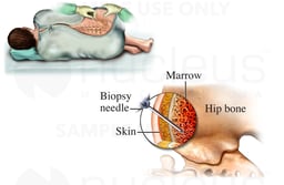 Side-lying Bone Biopsy
