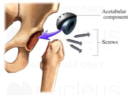 THR: Acetabular Component