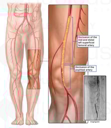 Arterial Blockage of Left Leg (Pre-operative Angiogram)