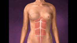 Breast Reconstruction Surgery