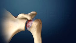 Understanding Shoulder Arthritis