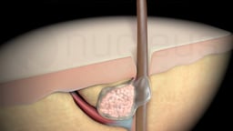 Healthy Hair Follicle and Sebaceous Gland in Cross-Section