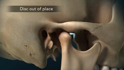 Anterior Displacement of TMJ Articular Disc