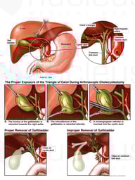 Correct vs. Incorrect Cholecystectomy Procedure